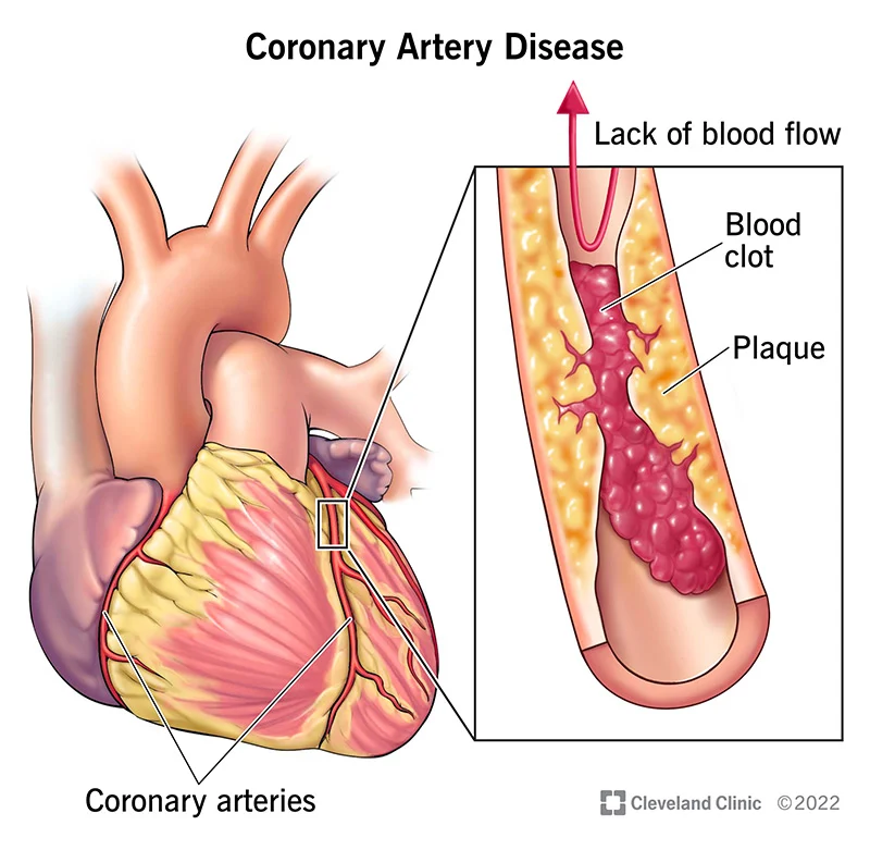 16898-coronary-artery-disease.webp