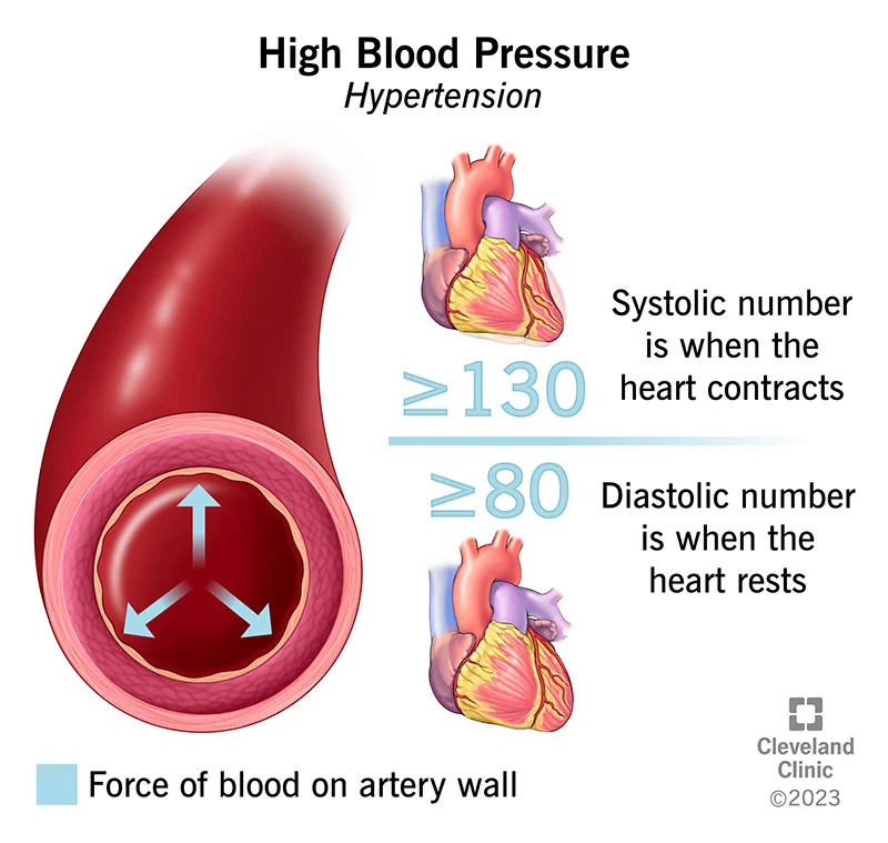 4314-high-blood-pressure-illustration.webp