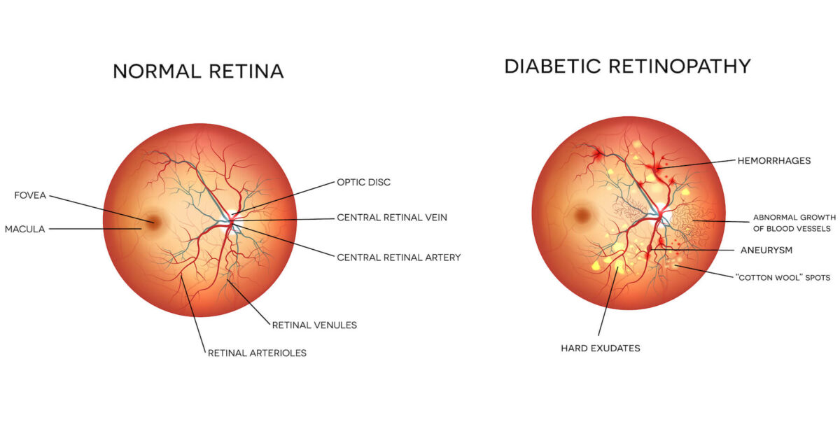 diabetic-retinopathy-vector-1200x633.jpg