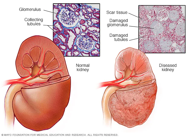 mcdc7_diseased_kidney-8col.webp